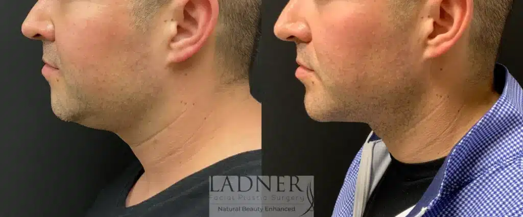 Before and After Image: Minimally Invasive Neck Tightening, Chin Augmentation, and Facial Plastic Surgery for Men - left-side