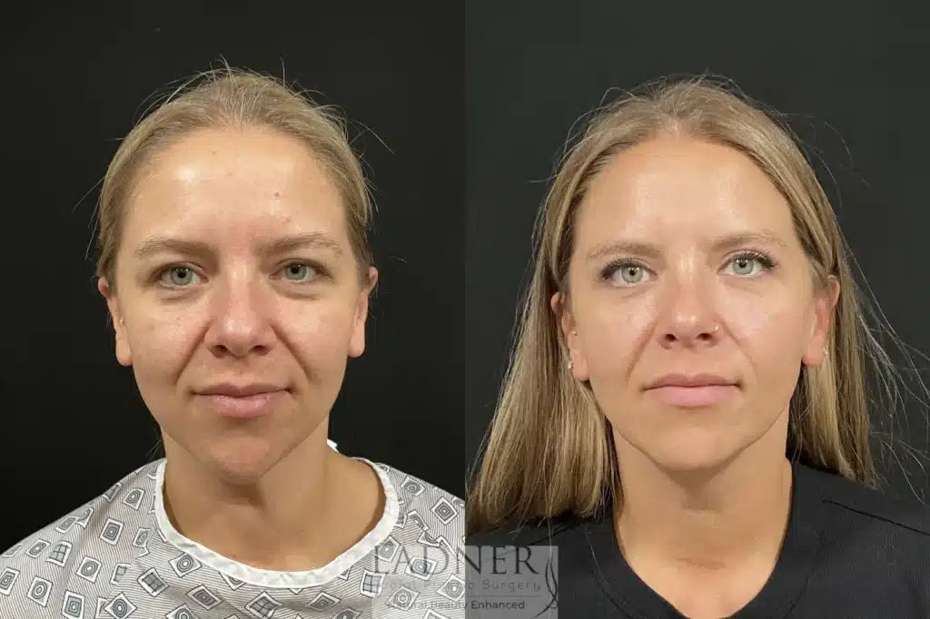 Before and After Image: Upper Blepharoplasty & Submental Liposuction - front
