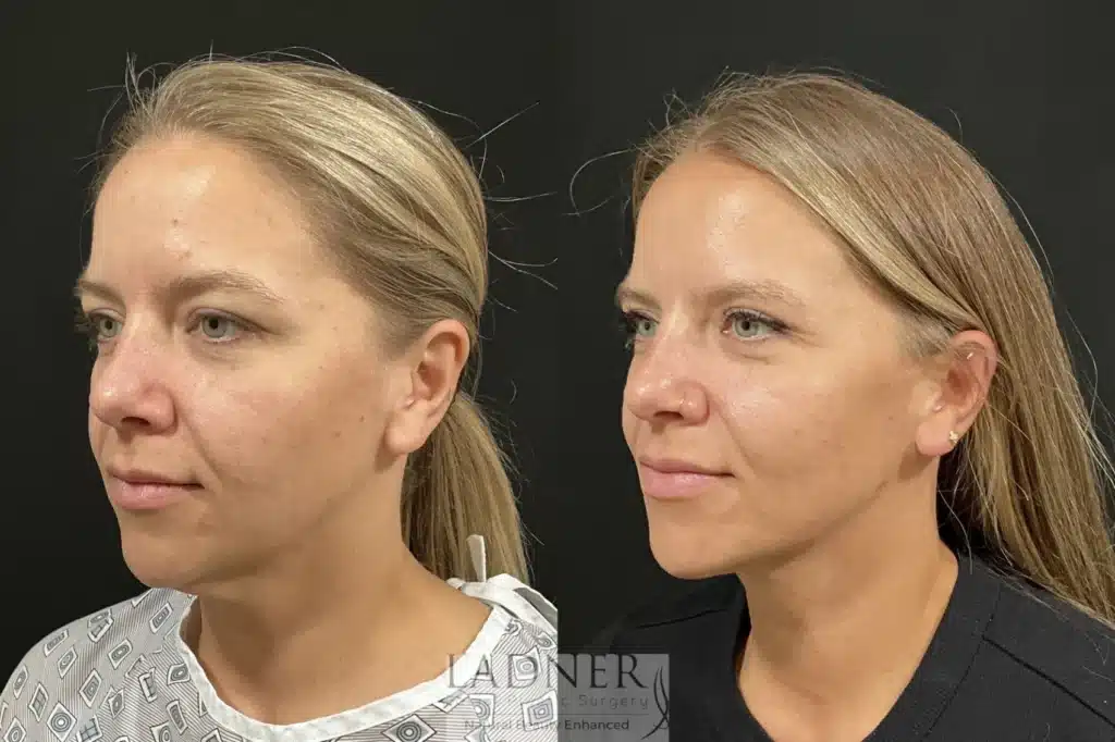 Before and After Image: Upper Blepharoplasty & Submental Liposuction - left-front-oblique
