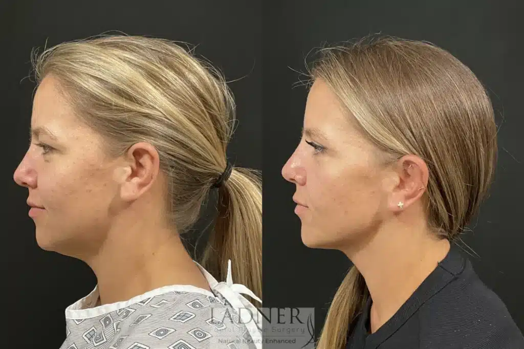 Before and After Image: Upper Blepharoplasty & Submental Liposuction - left-side