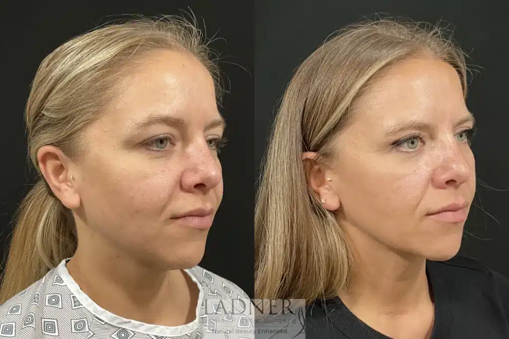 Before and After Image: Upper Blepharoplasty & Submental Liposuction - right-front-oblique