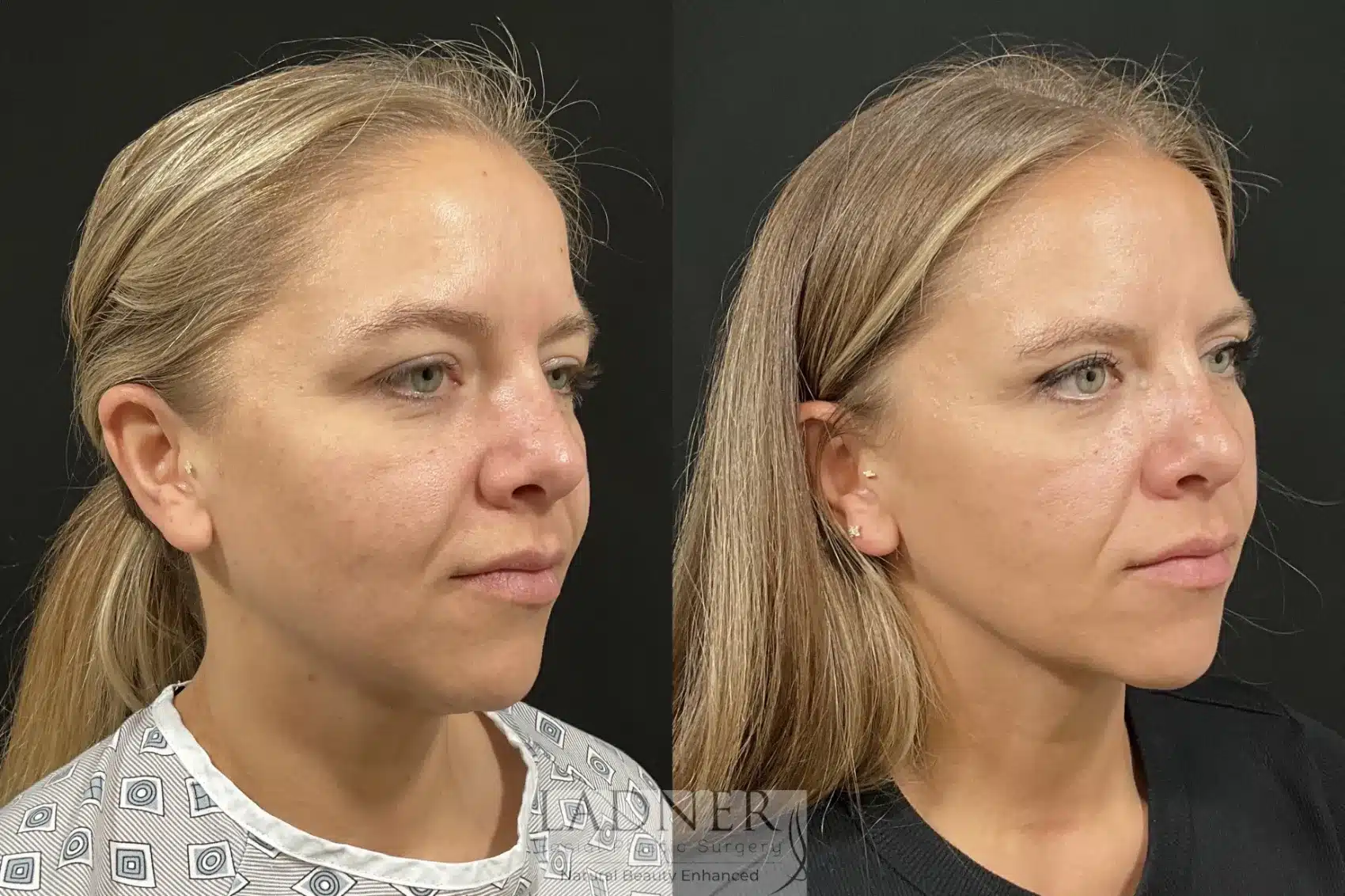 Before and After Image: Upper Blepharoplasty - right-front-oblique