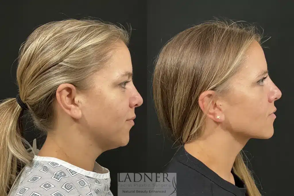 Before and After Image: Upper Blepharoplasty & Submental Liposuction - right-side