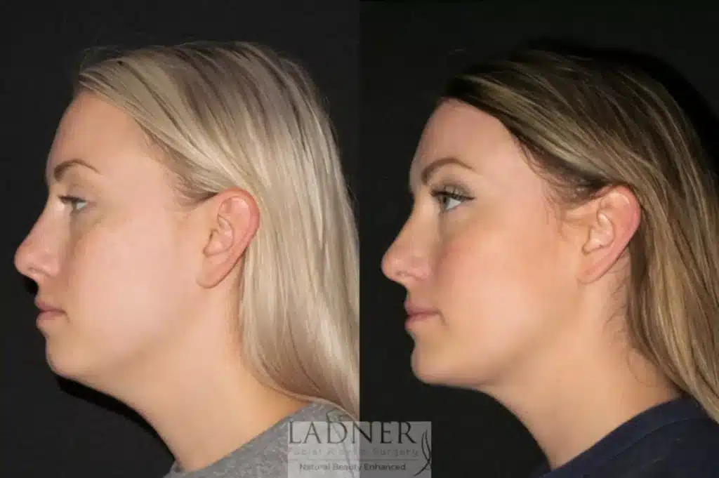 Before and After Image: Minimally Invasive Neck Tightening & Chin Augmentation - left-side