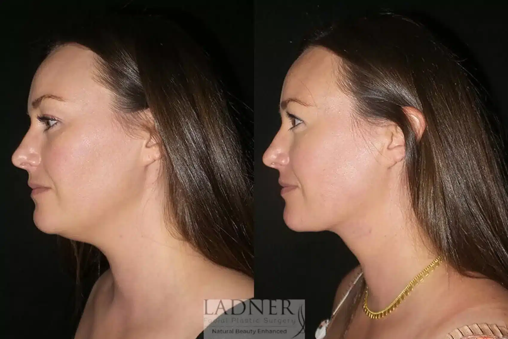 Before and After Image: Minimally Invasive Neck Tightening - left-side