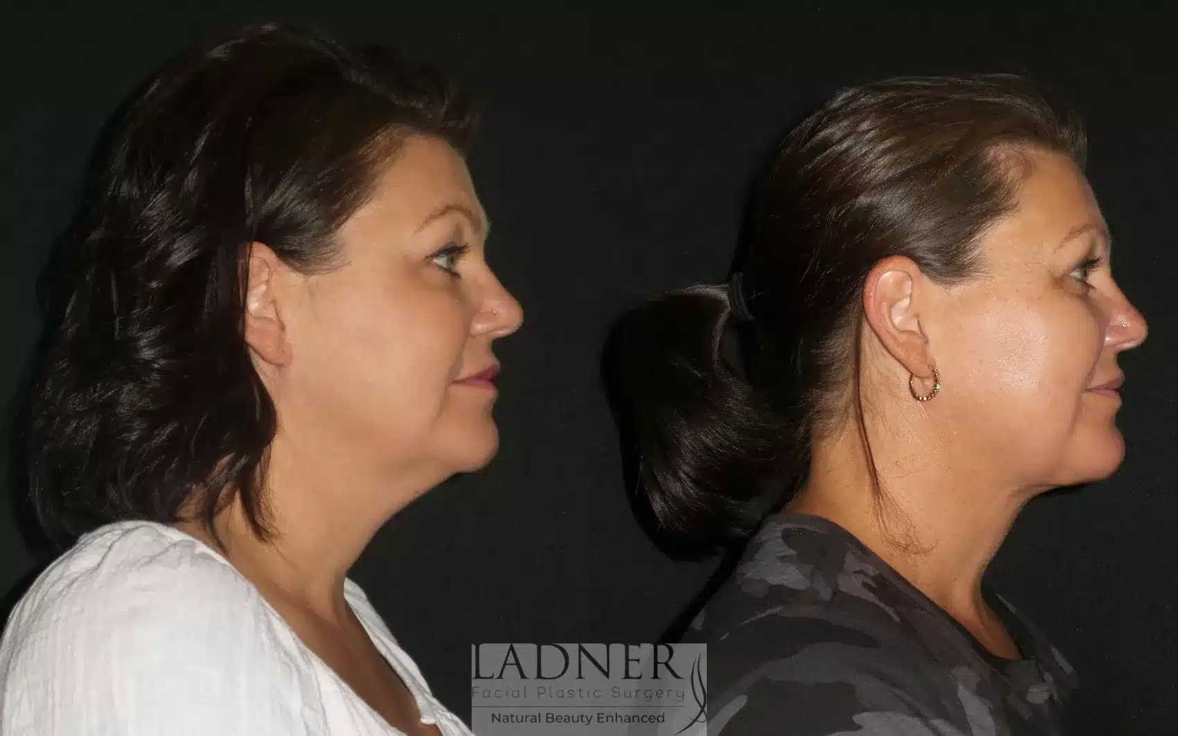 Before and After Image: Minimally Invasive Neck Tightening - right-side