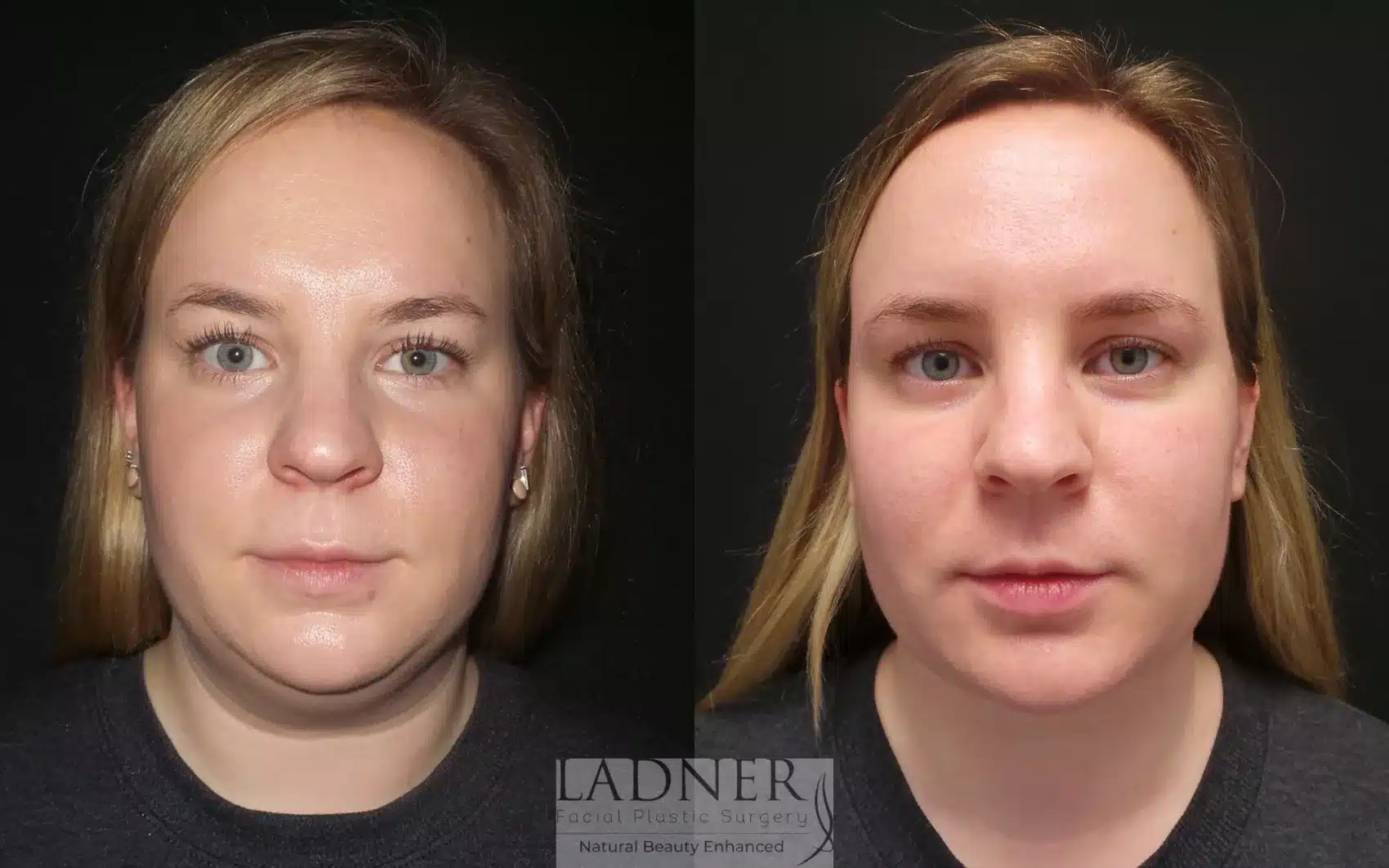 Before and After Image: Submental & Submandibular Liposuction - front