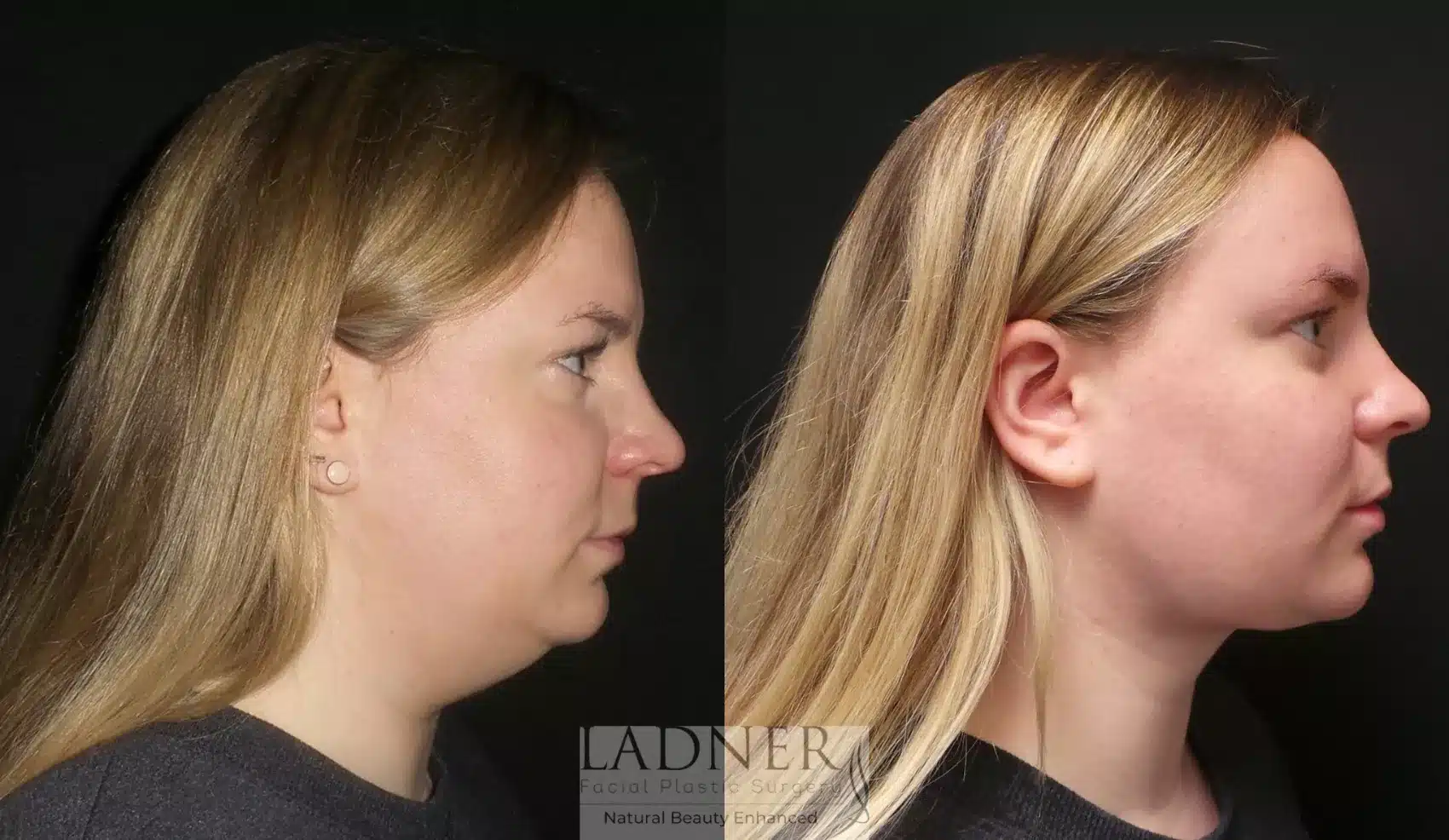 Before and After Image: Submental & Submandibular Liposuction - right-side