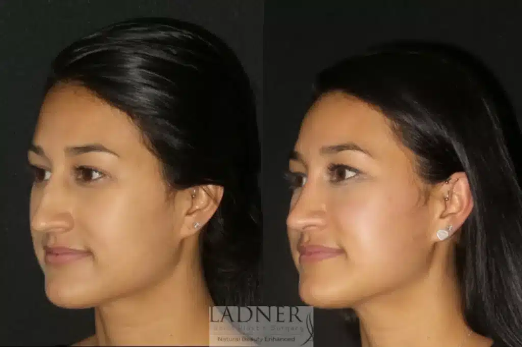 Before and After Image: Rhinoplasty - left-front-oblique