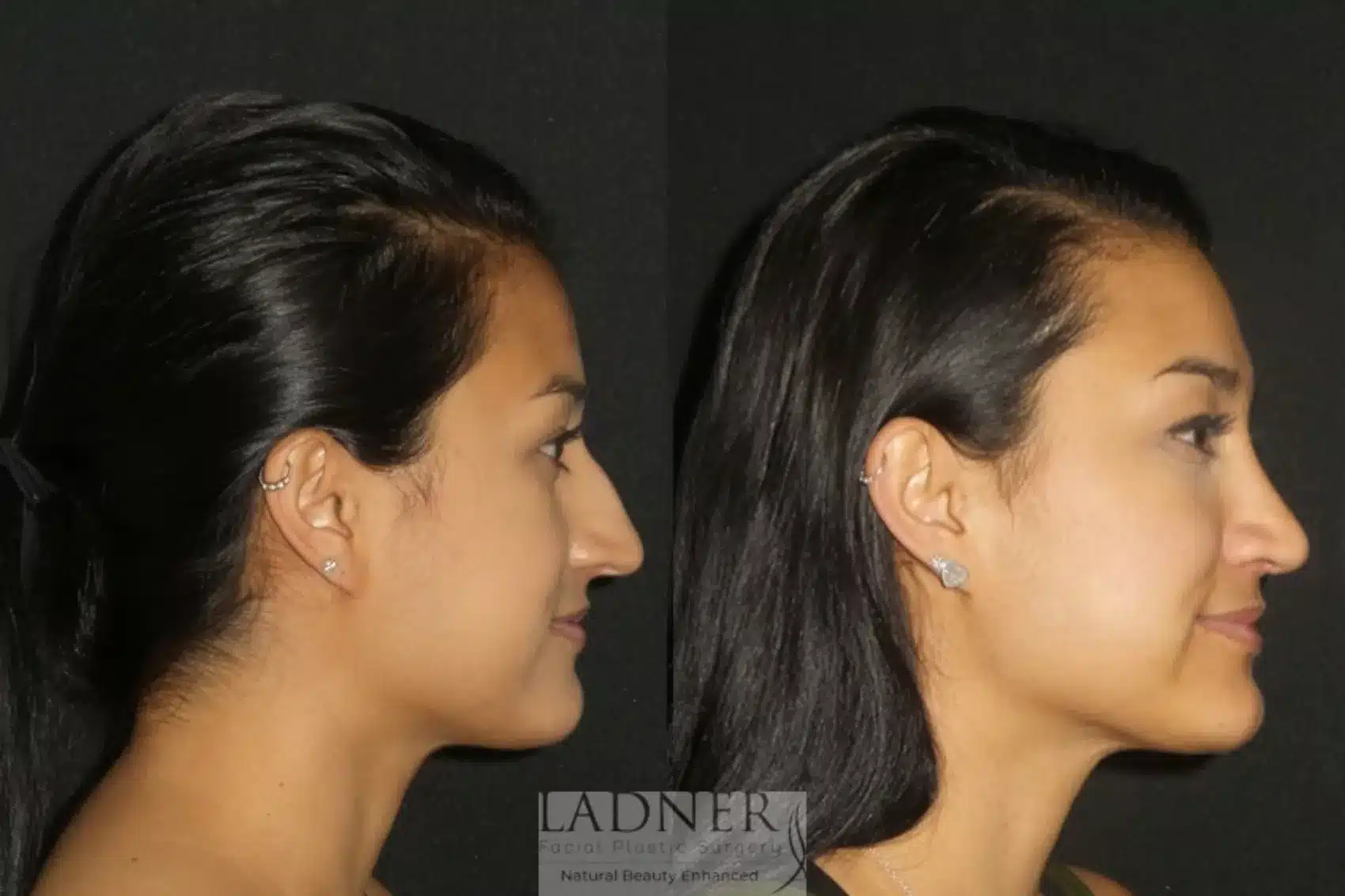Before and After Image: Rhinoplasty - right-side