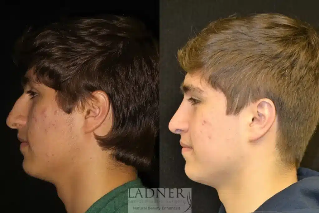 Before and After Image: Rhinoplasty & Facial Plastic Surgery for Men - left-side