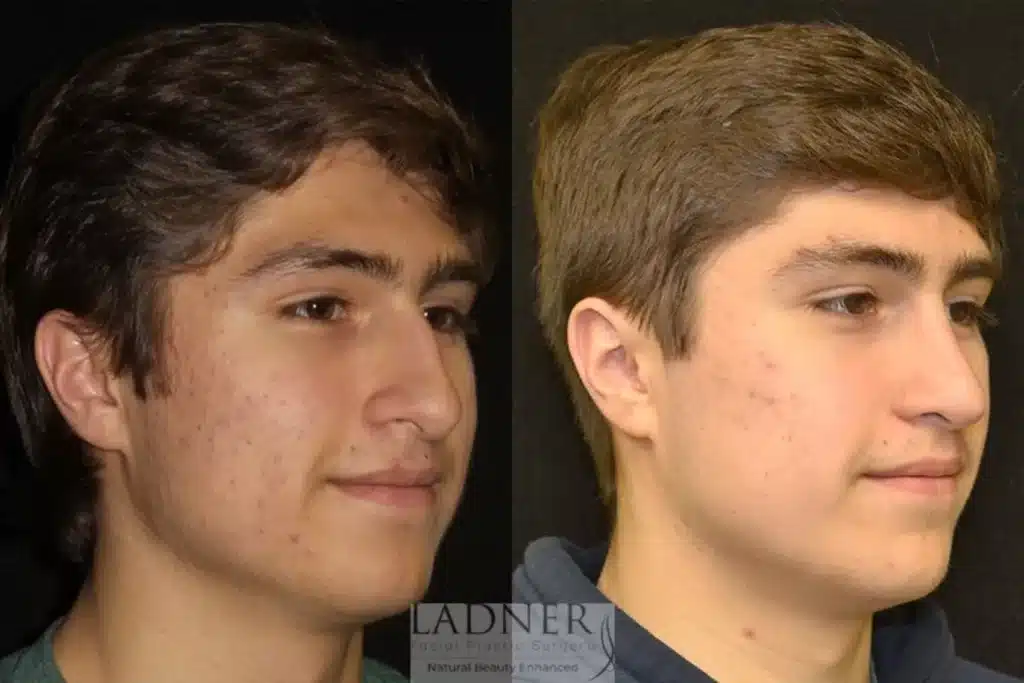 Before and After Image: Rhinoplasty & Facial Plastic Surgery for Men - right-front-oblique