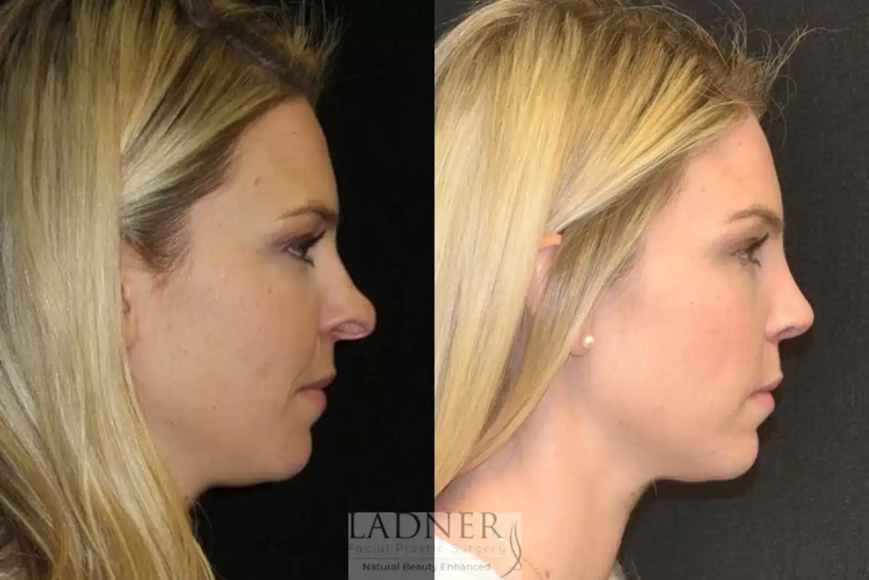 Before and After Image: Rhinoplasty - right-side