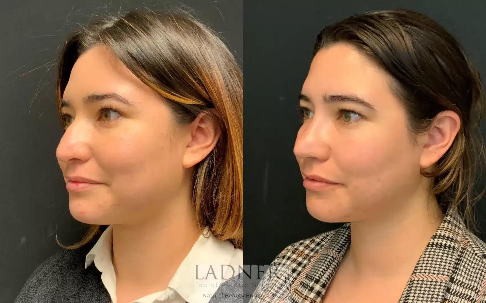 Before and After Image: Rhinoplasty - left-front-oblique