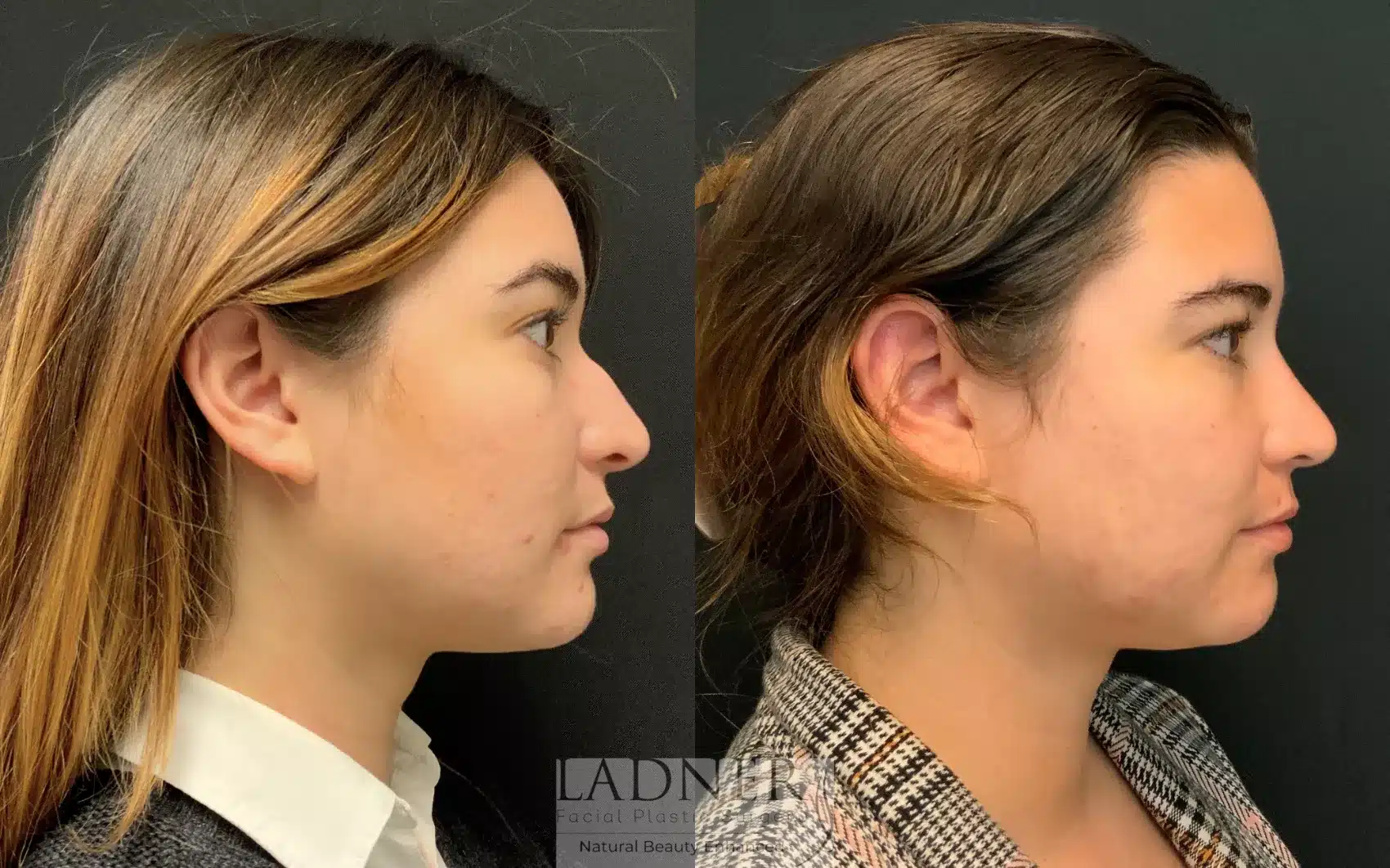 Before and After Image: Rhinoplasty - right-side