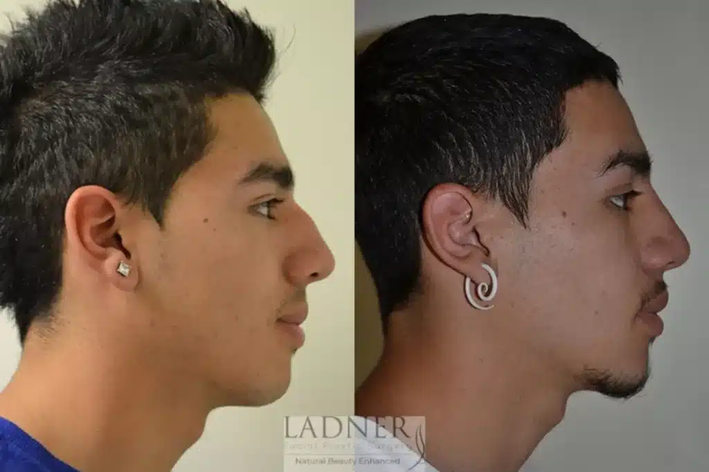 Before and After Image: Rhinoplasty & Facial Plastic Surgery for Men - right-side