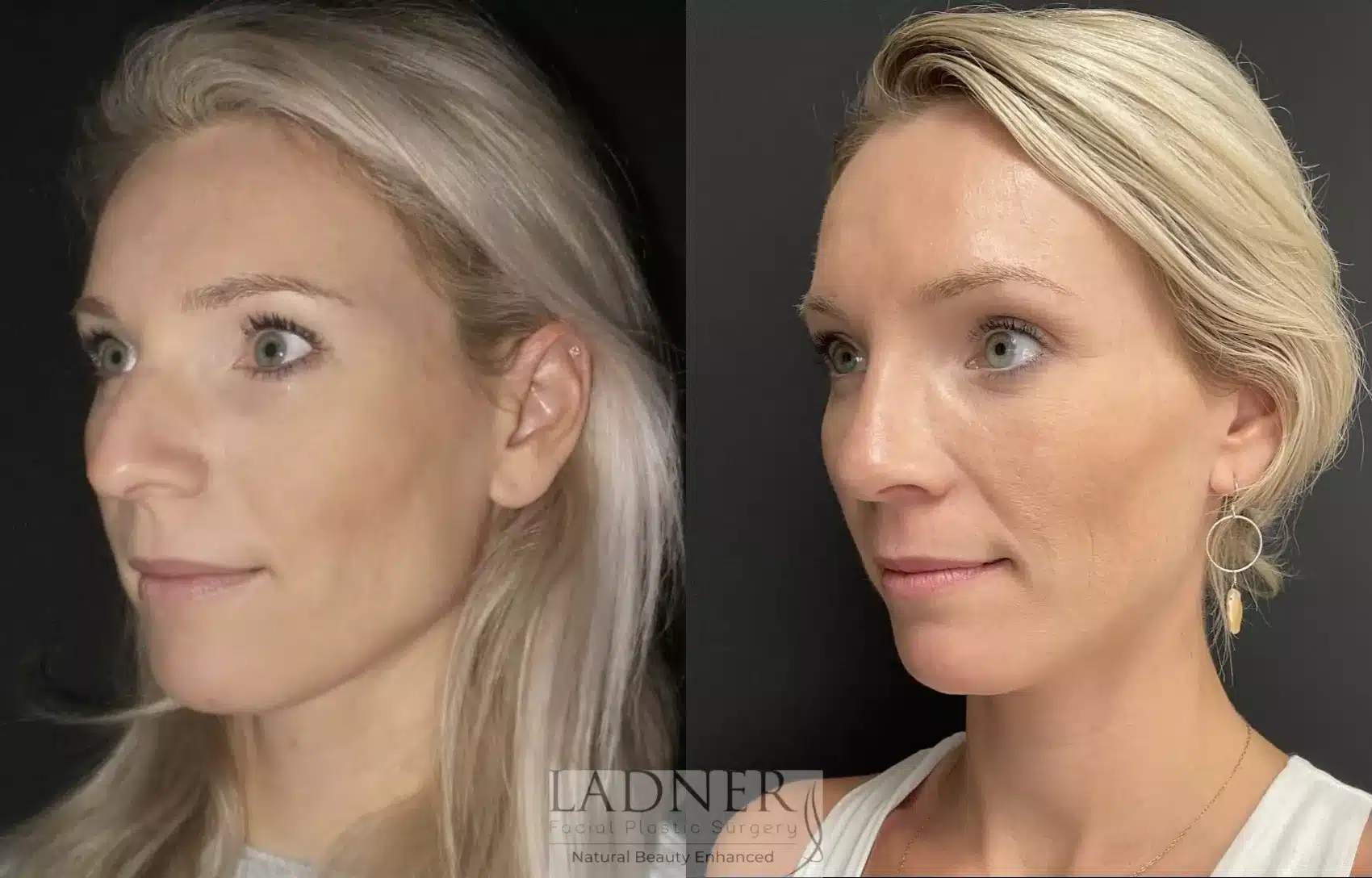 Before and After Image: Rhinoplasty - left-front-oblique