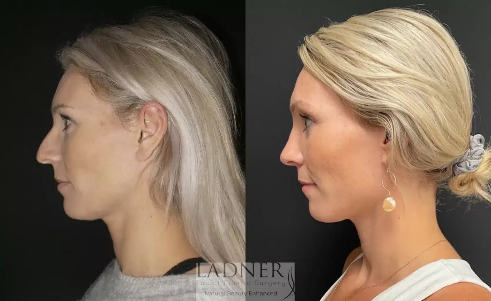 Before and After Image: Rhinoplasty - left-side