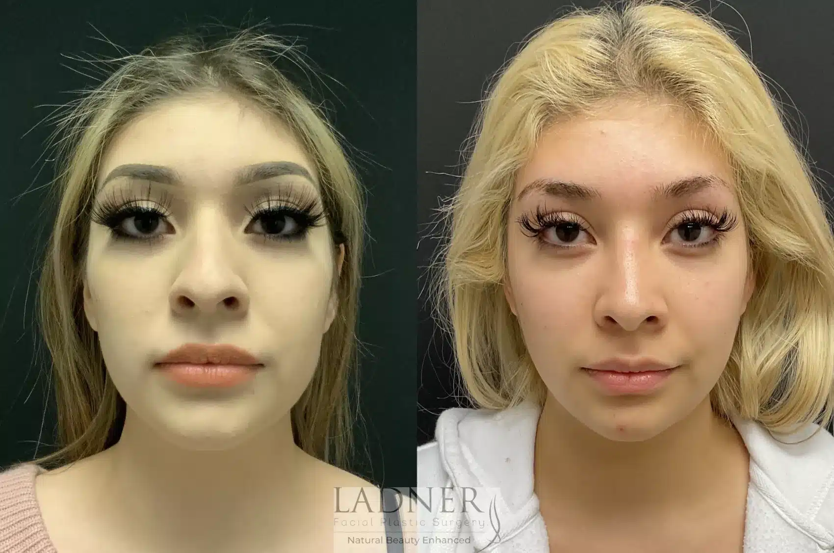 Before and After Image: Rhinoplasty - front
