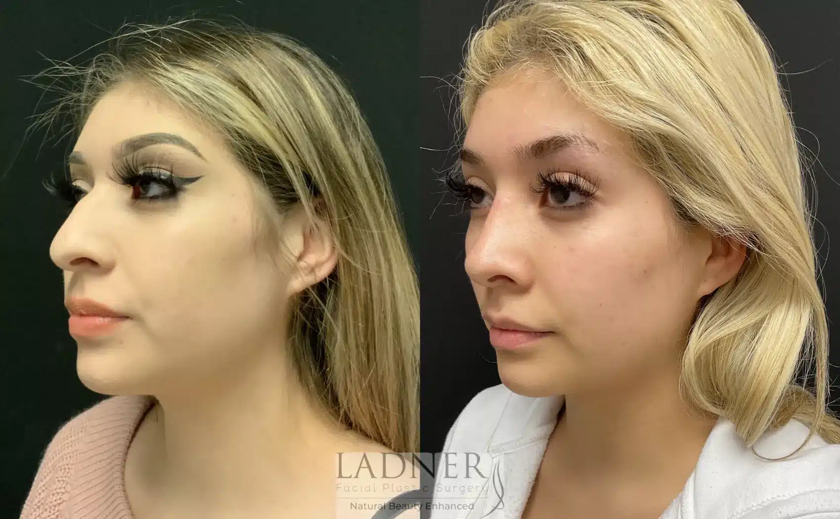 Before and After Image: Rhinoplasty - left-front-oblique