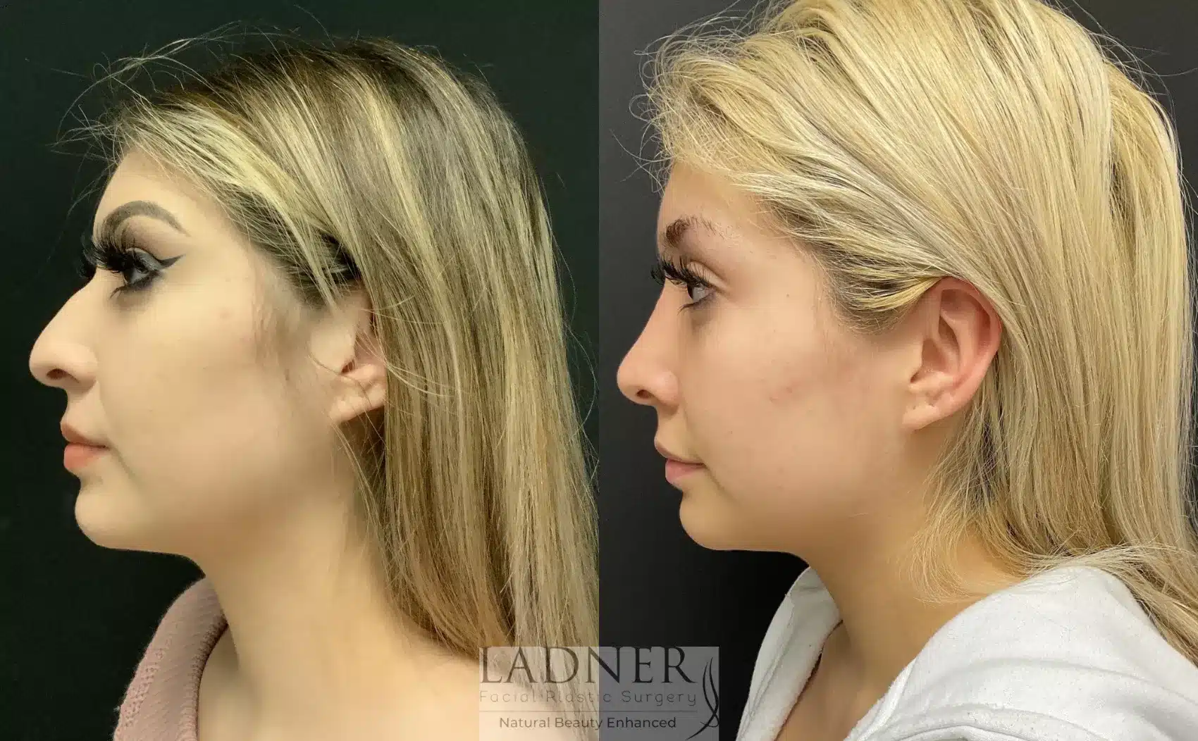 Before and After Image: Rhinoplasty - left-side