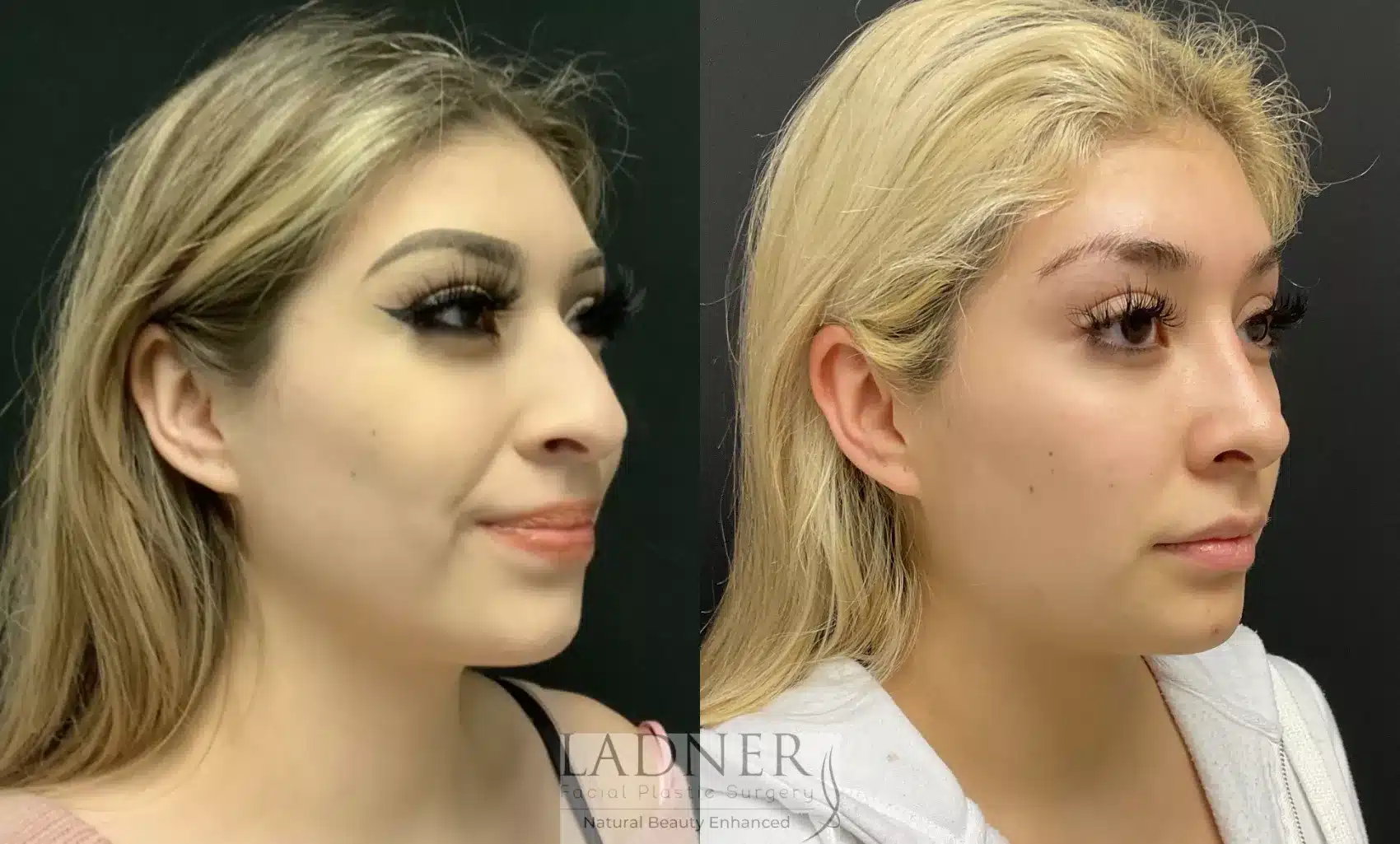 Before and After Image: Rhinoplasty - right-front-oblique