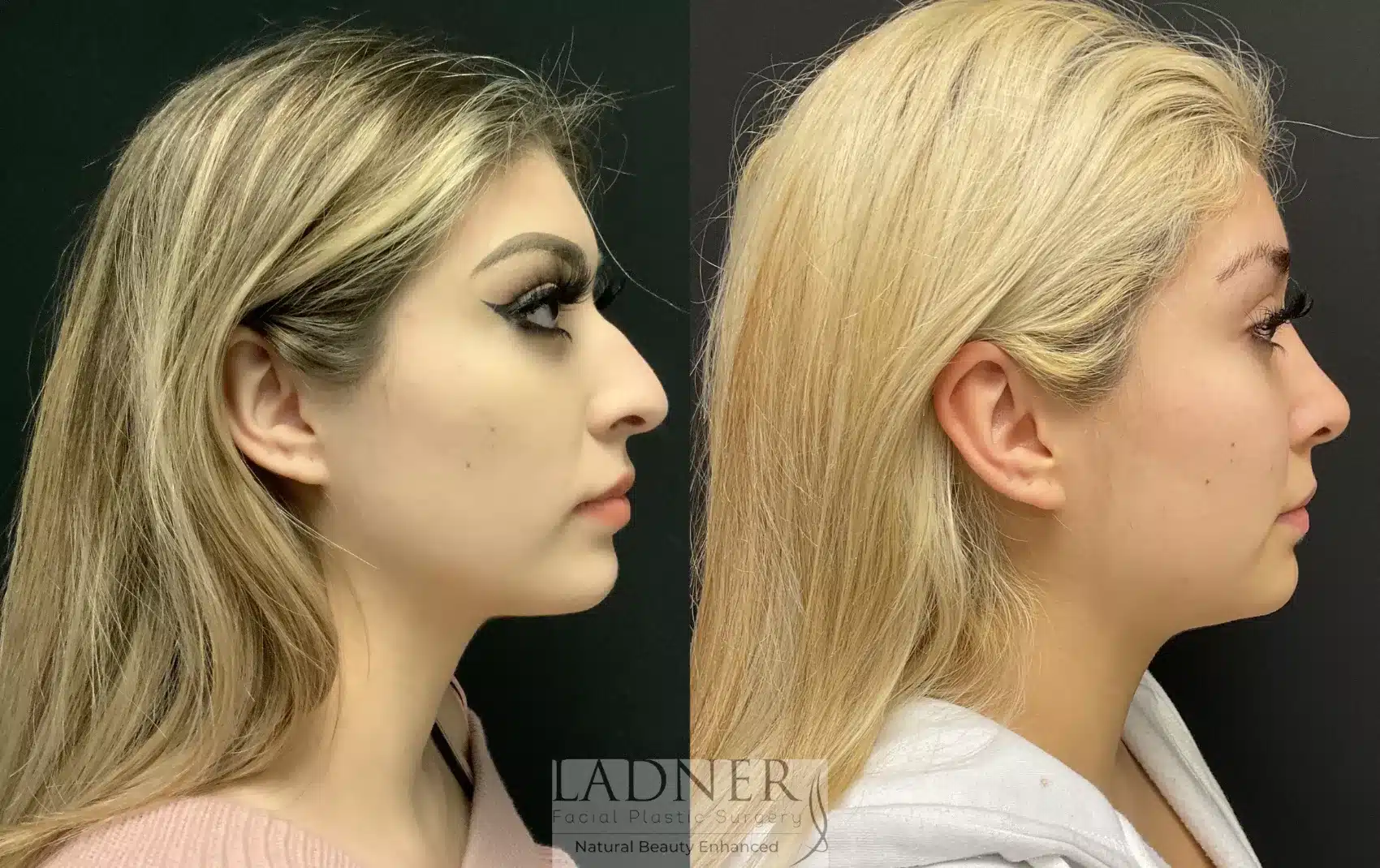 Before and After Image: Rhinoplasty - right-side