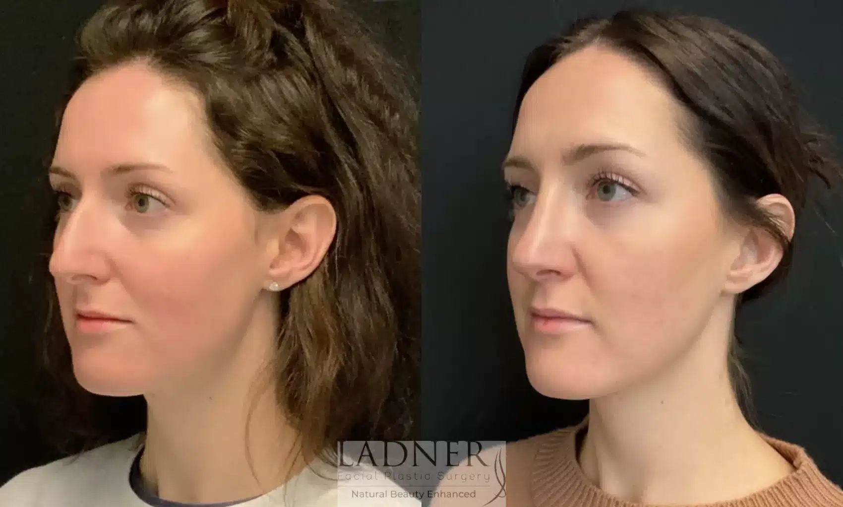 Before and After Image: Rhinoplasty - left-front-oblique