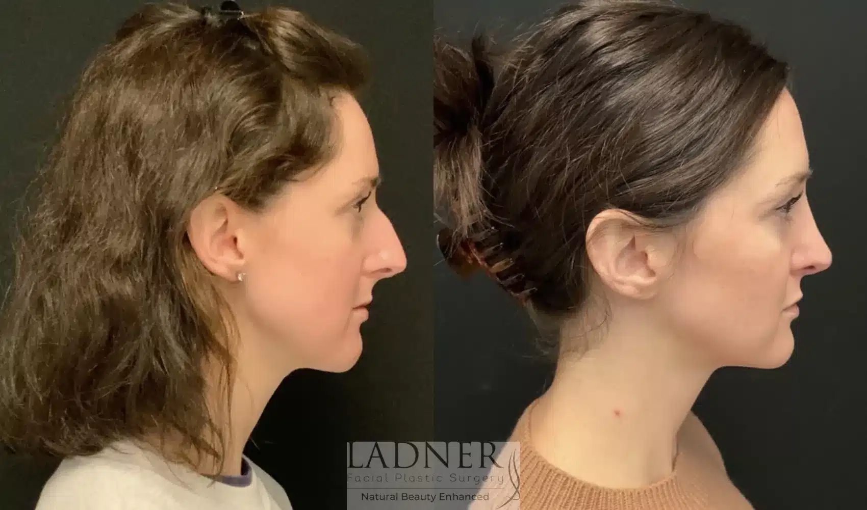 Before and After Image: Rhinoplasty - right-side