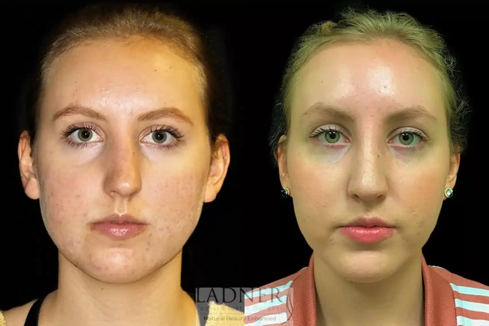 Before and After Image: Rhinoplasty - front