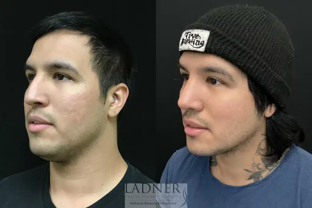 Before and After Image: Rhinoplasty & Facial Plastic Surgery for Men - left-front-oblique