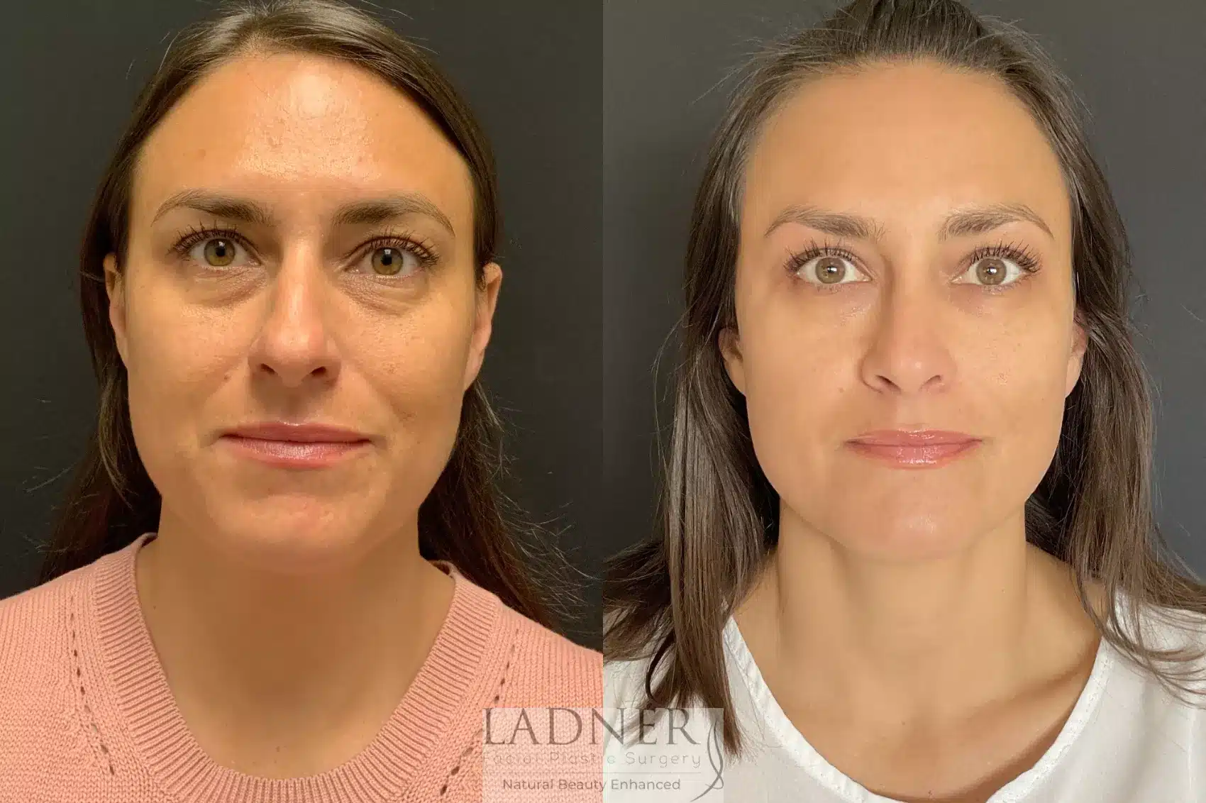 Before and After Image: Rhinoplasty - front