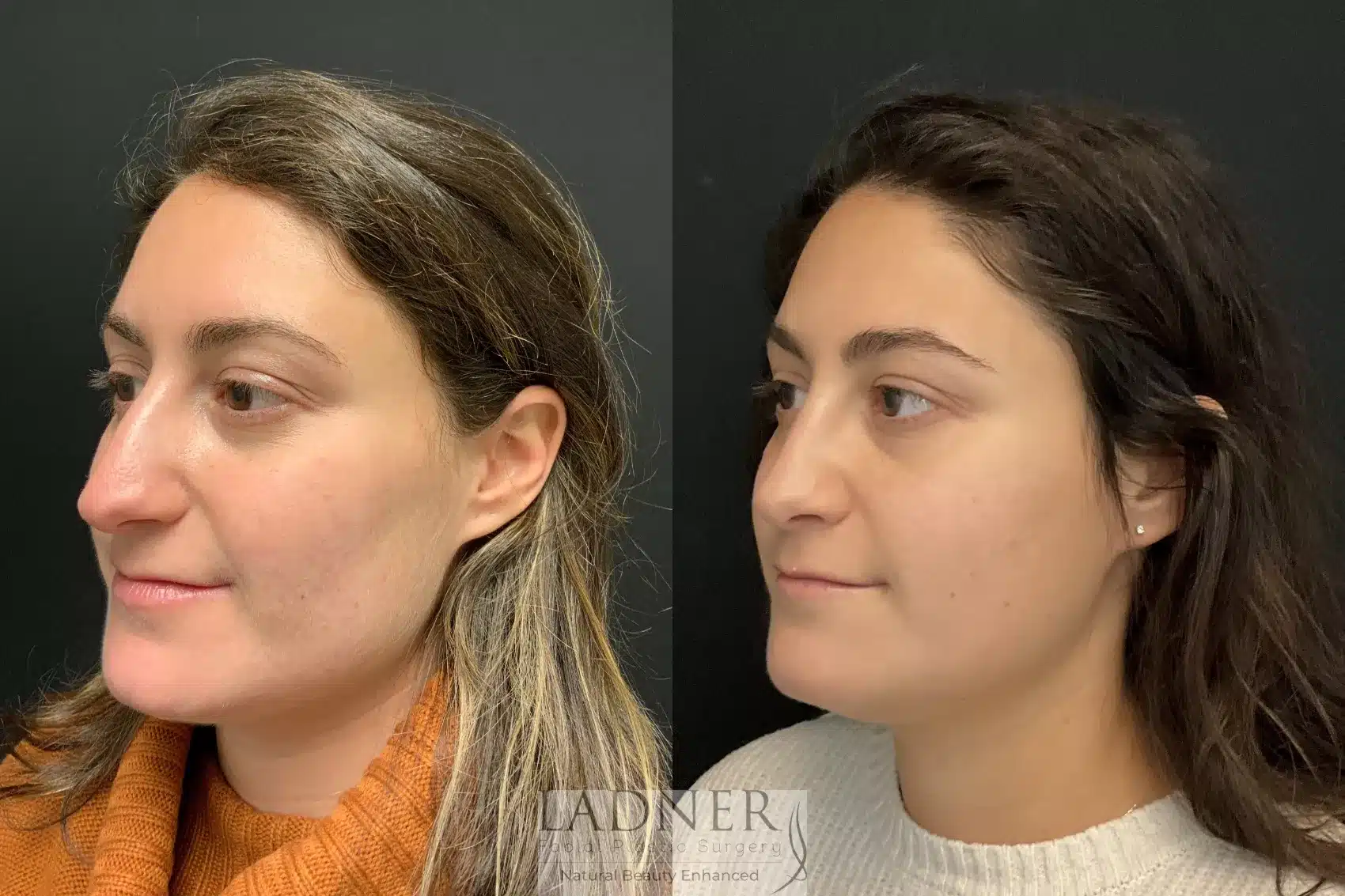 Before and After Image: Rhinoplasty - left-front-oblique