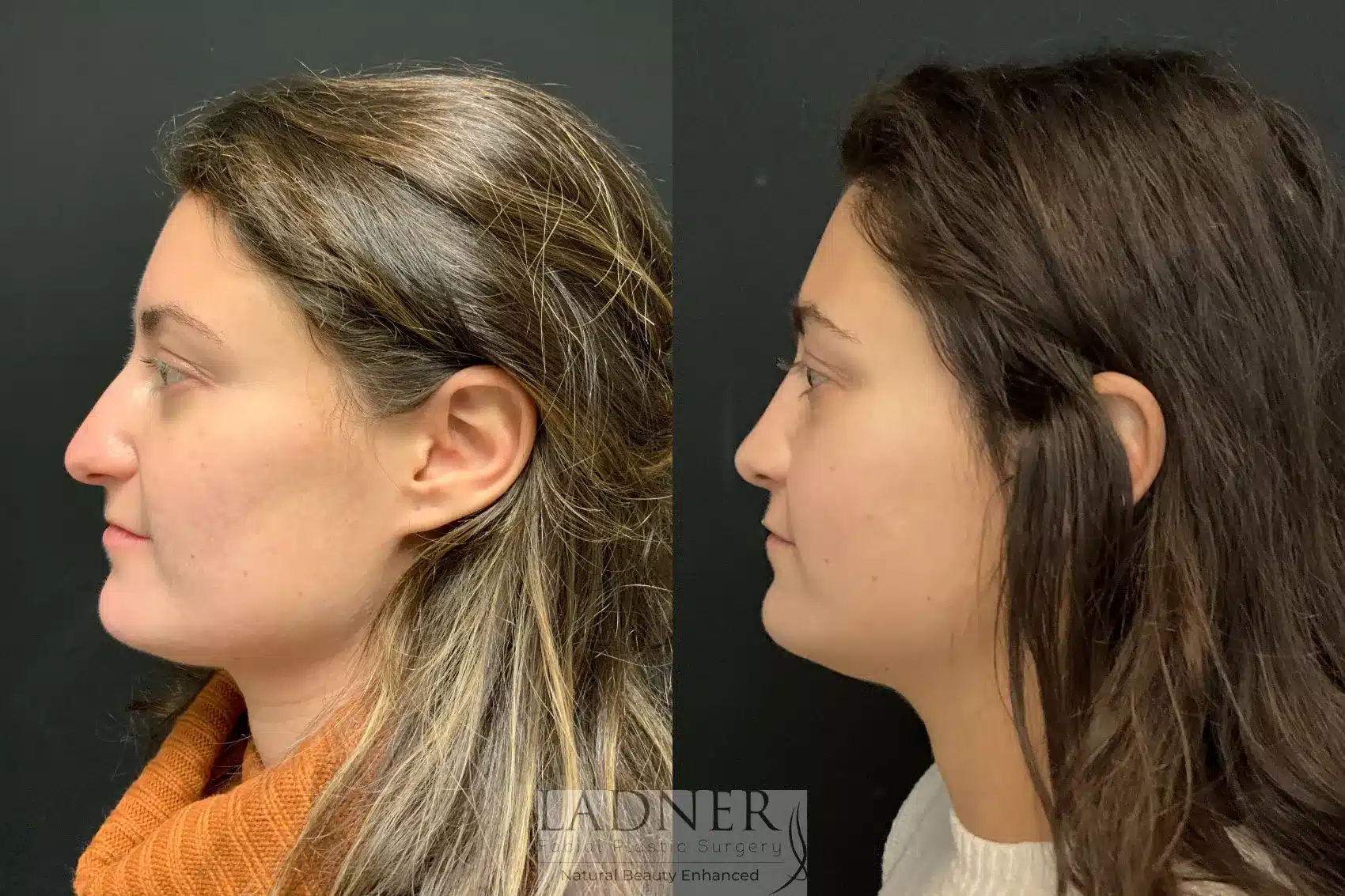 Before and After Image: Rhinoplasty - left-side