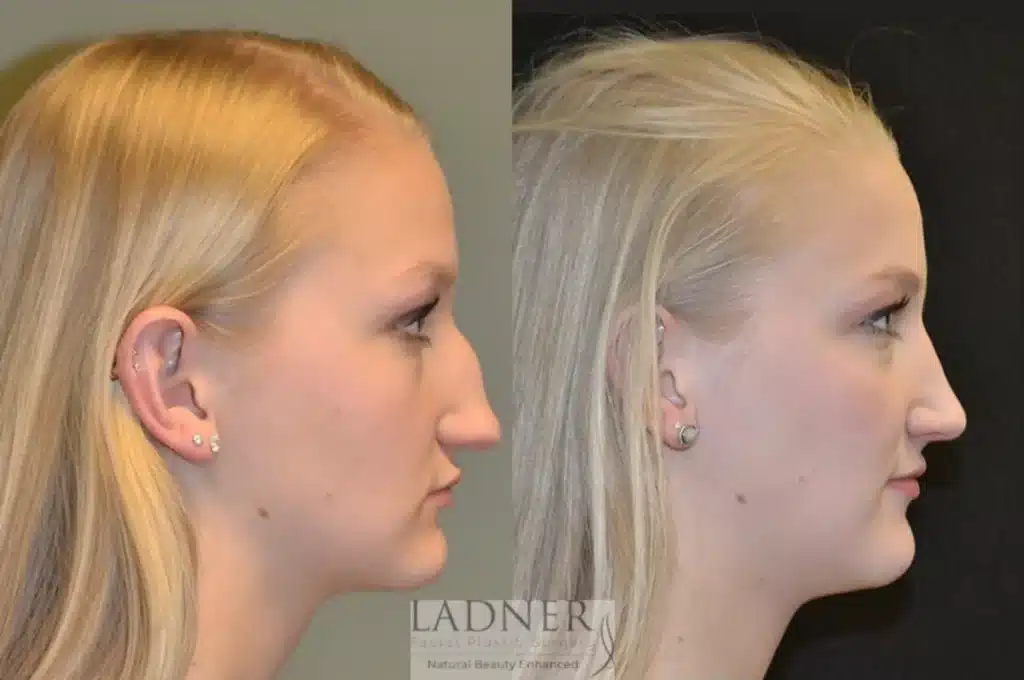 Before and After Image: Rhinoplasty - right-side