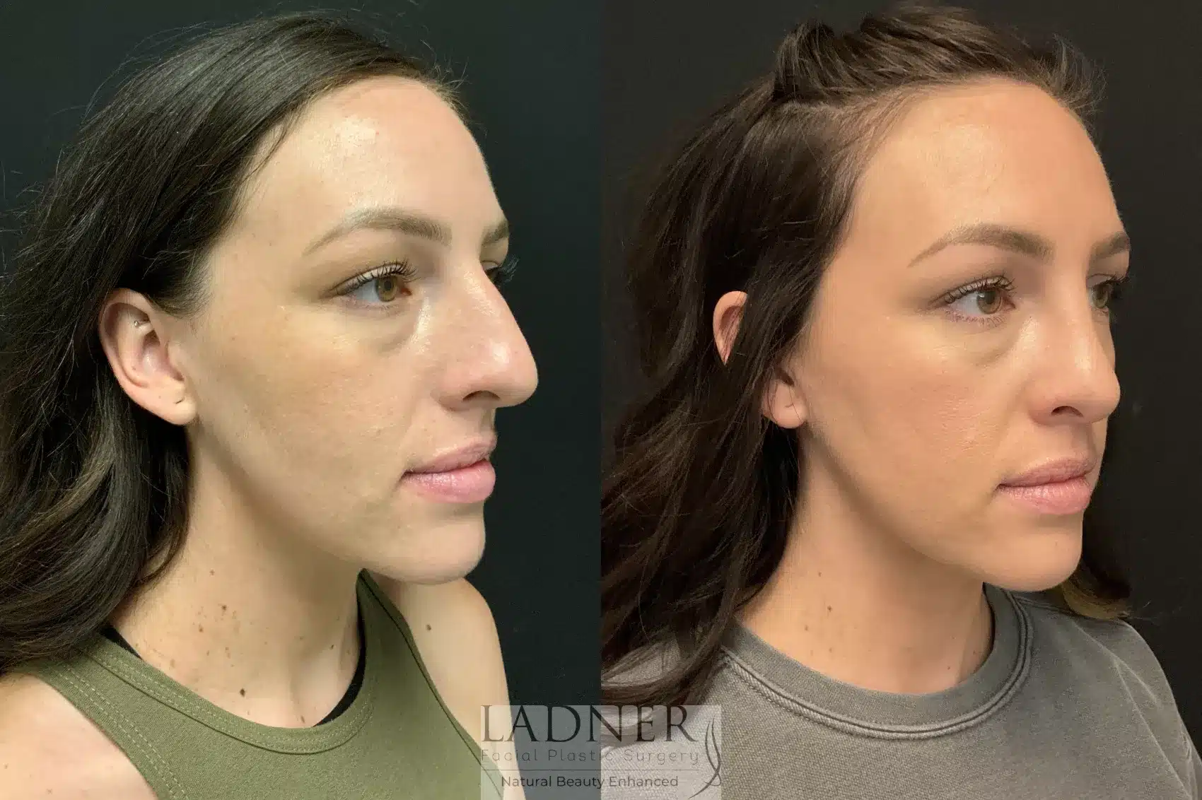 Before and After Image: Rhinoplasty - right-front-oblique