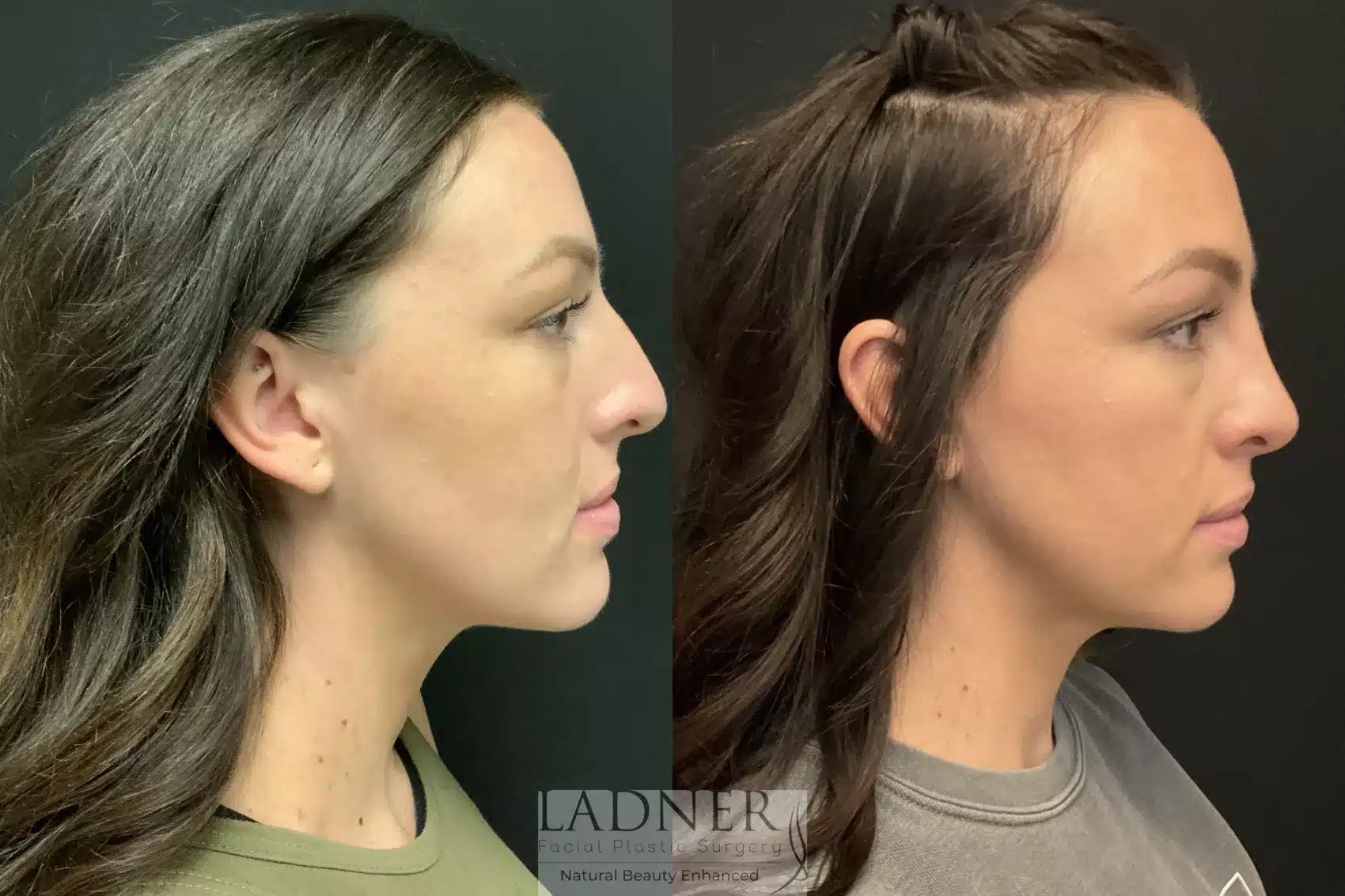 Before and After Image: Rhinoplasty - right-side