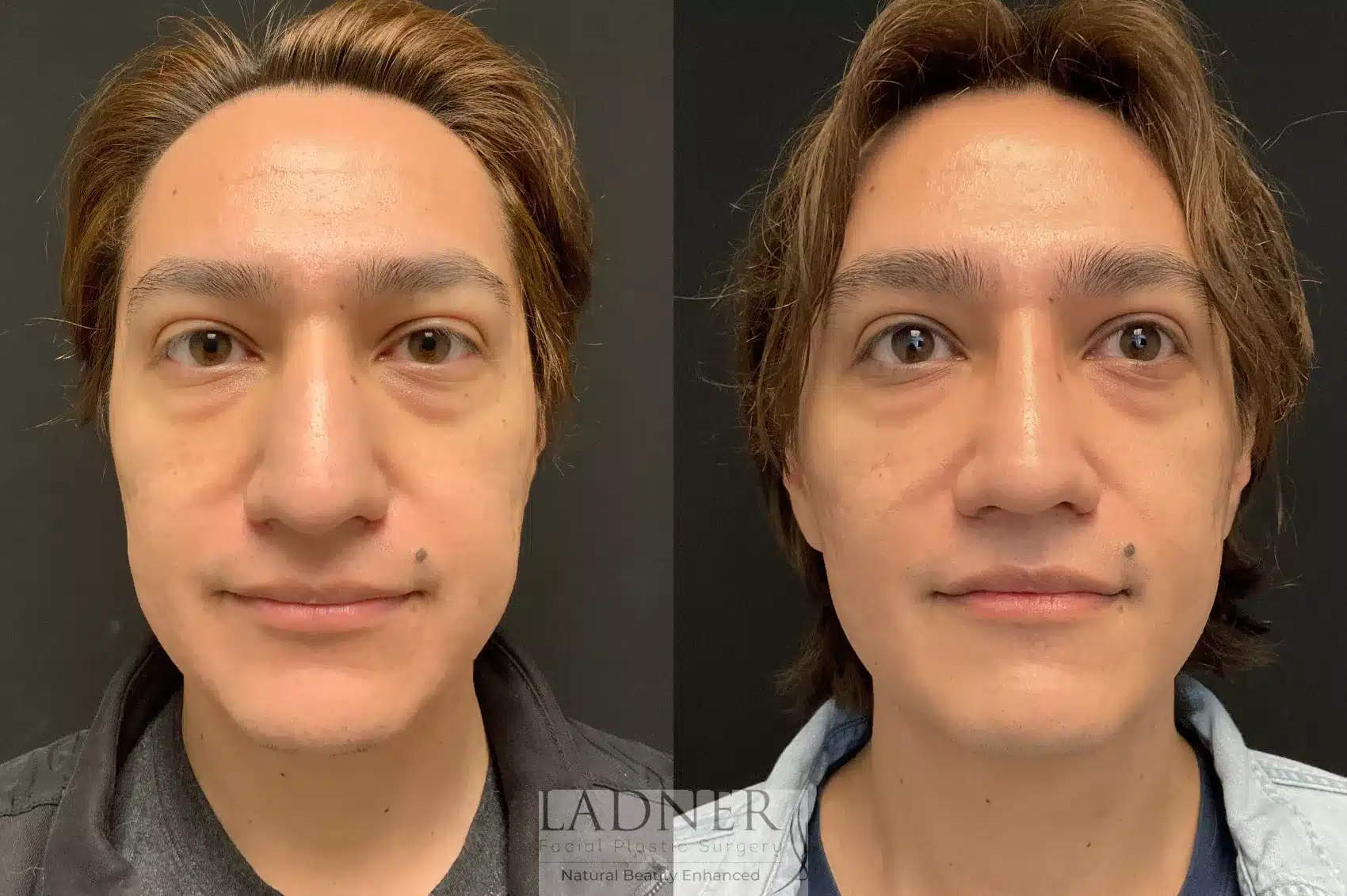 Before and After Image: Rhinoplasty - front