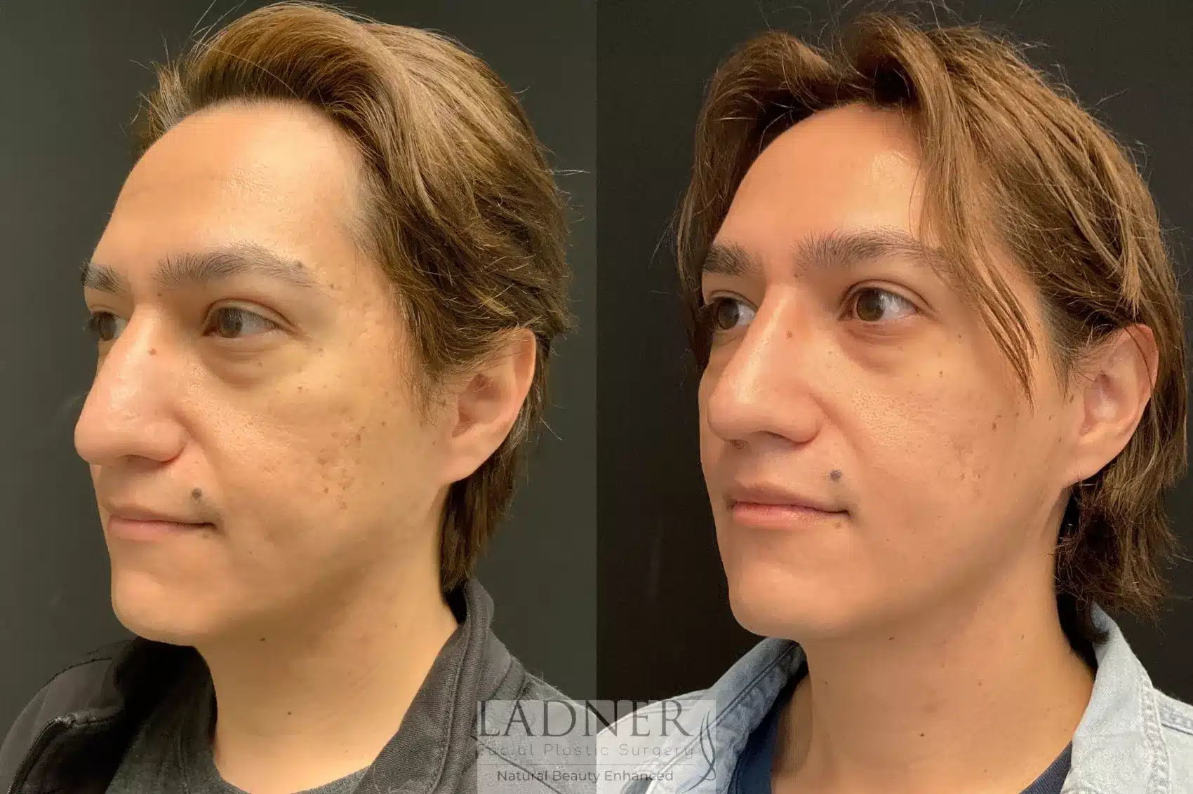 Before and After Image: Rhinoplasty - left-front-oblique