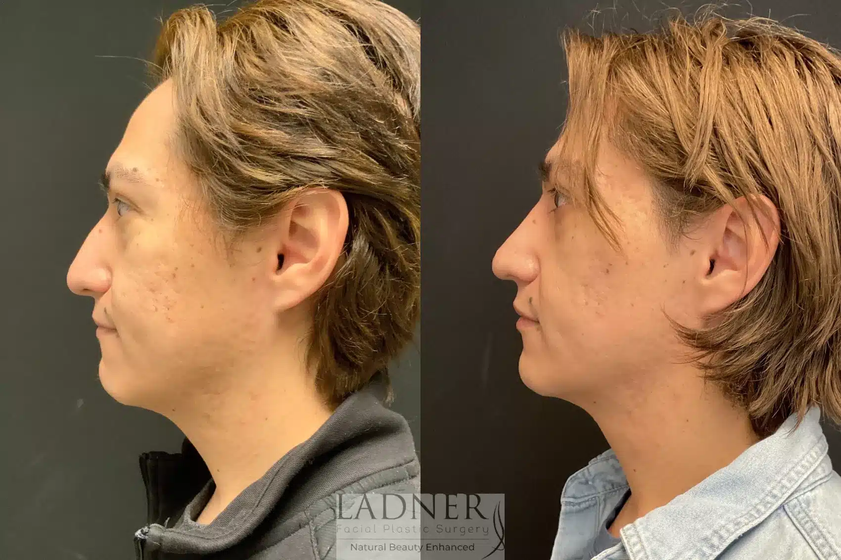 Before and After Image: Rhinoplasty - left-side