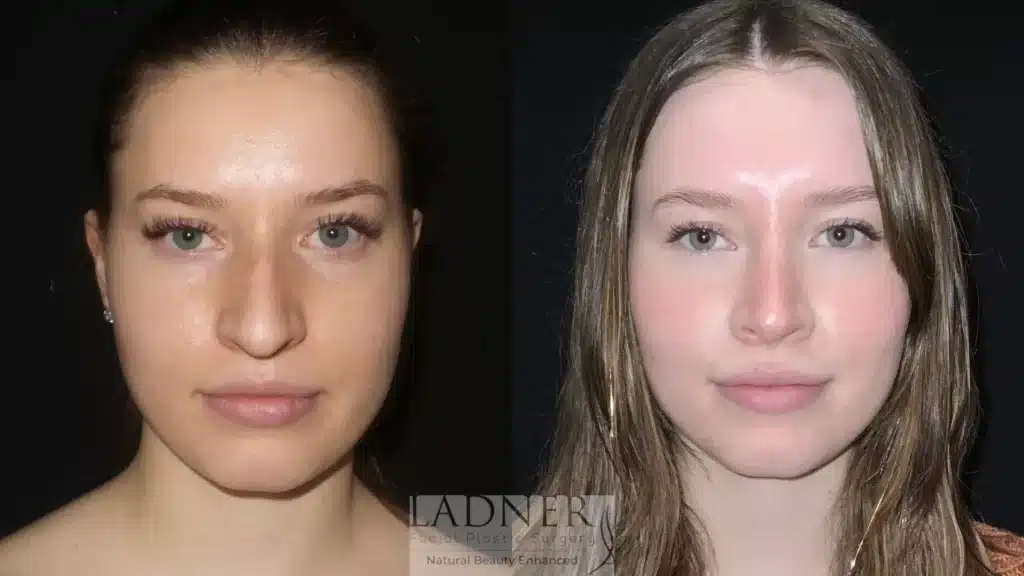 Before and After Image: Rhinoplasty - front