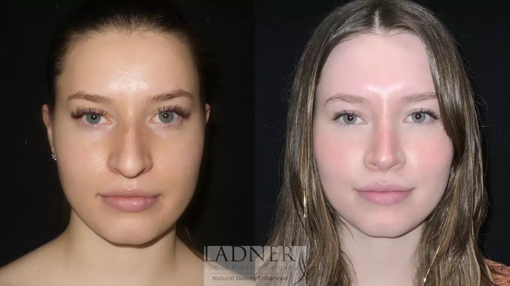 Before and After Image: Rhinoplasty - front