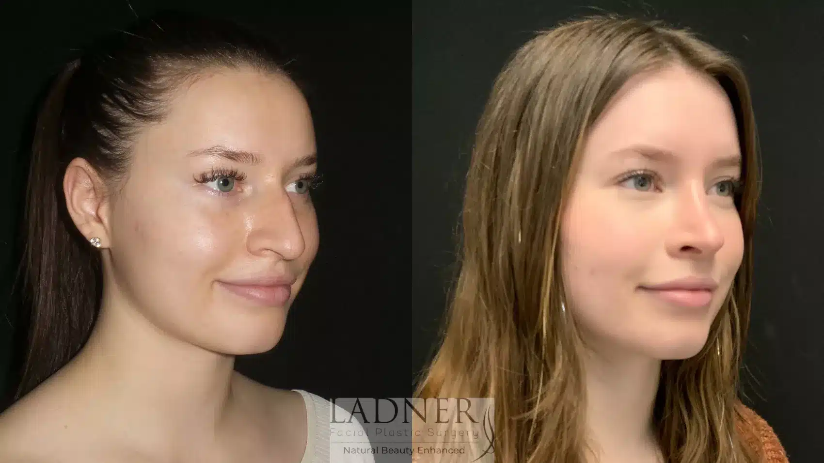 Before and After Image: Rhinoplasty - right-front-oblique