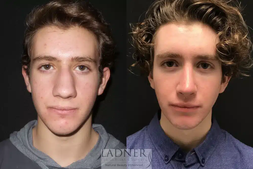 Before and After Image: Rhinoplasty & Facial Plastic Surgery for Men - front