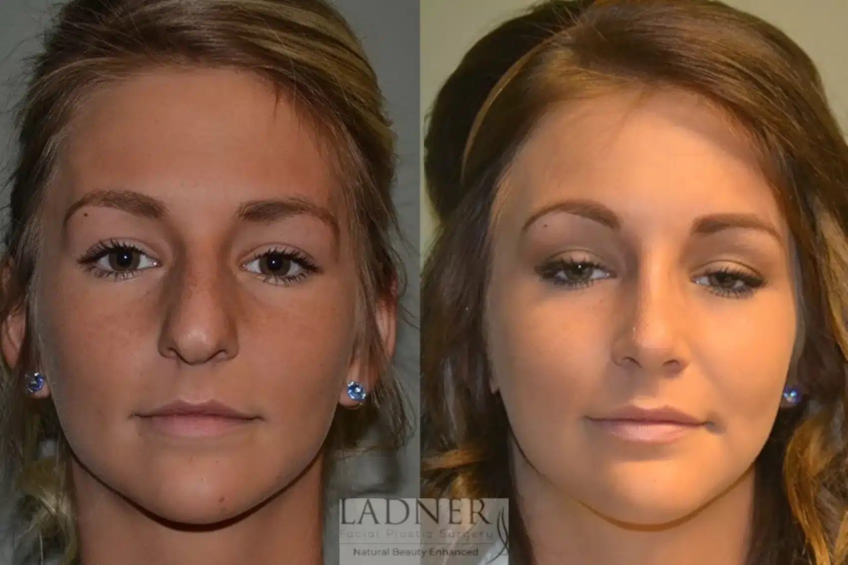 Before and After Image: Rhinoplasty - front