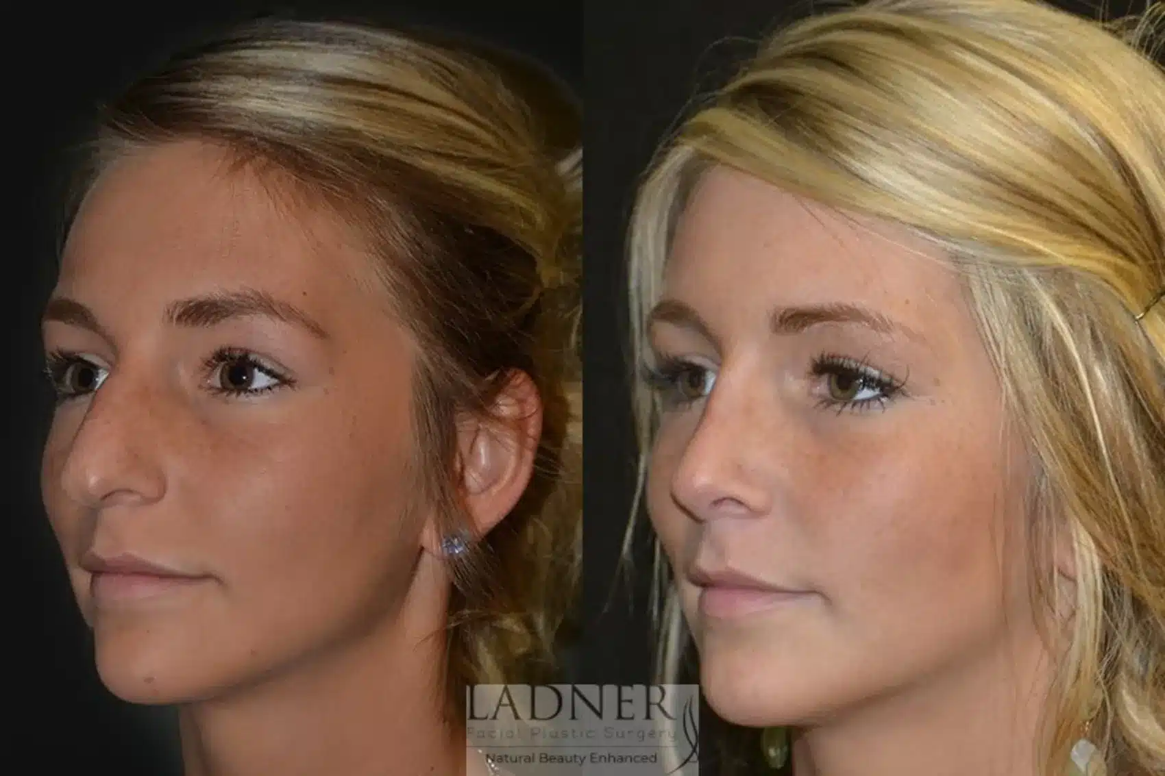 Before and After Image: Rhinoplasty - left-front-oblique