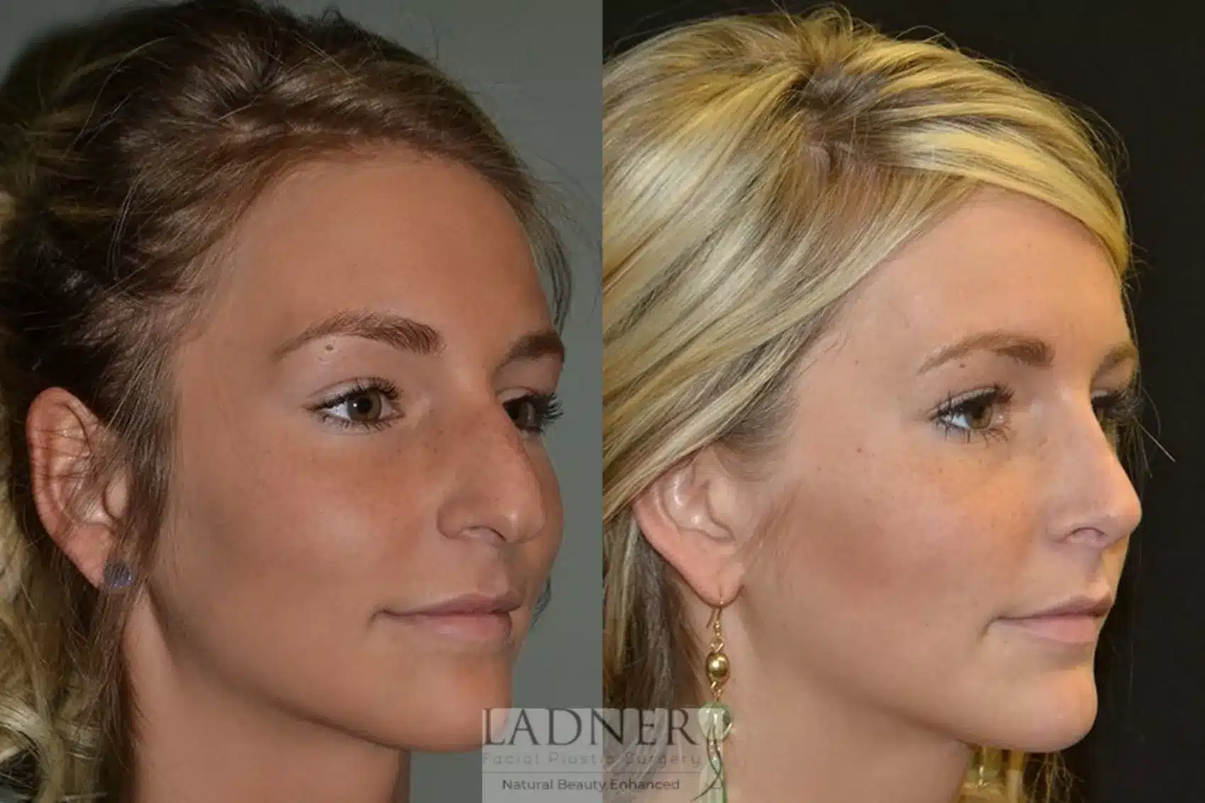 Before and After Image: Rhinoplasty - right-front-oblique