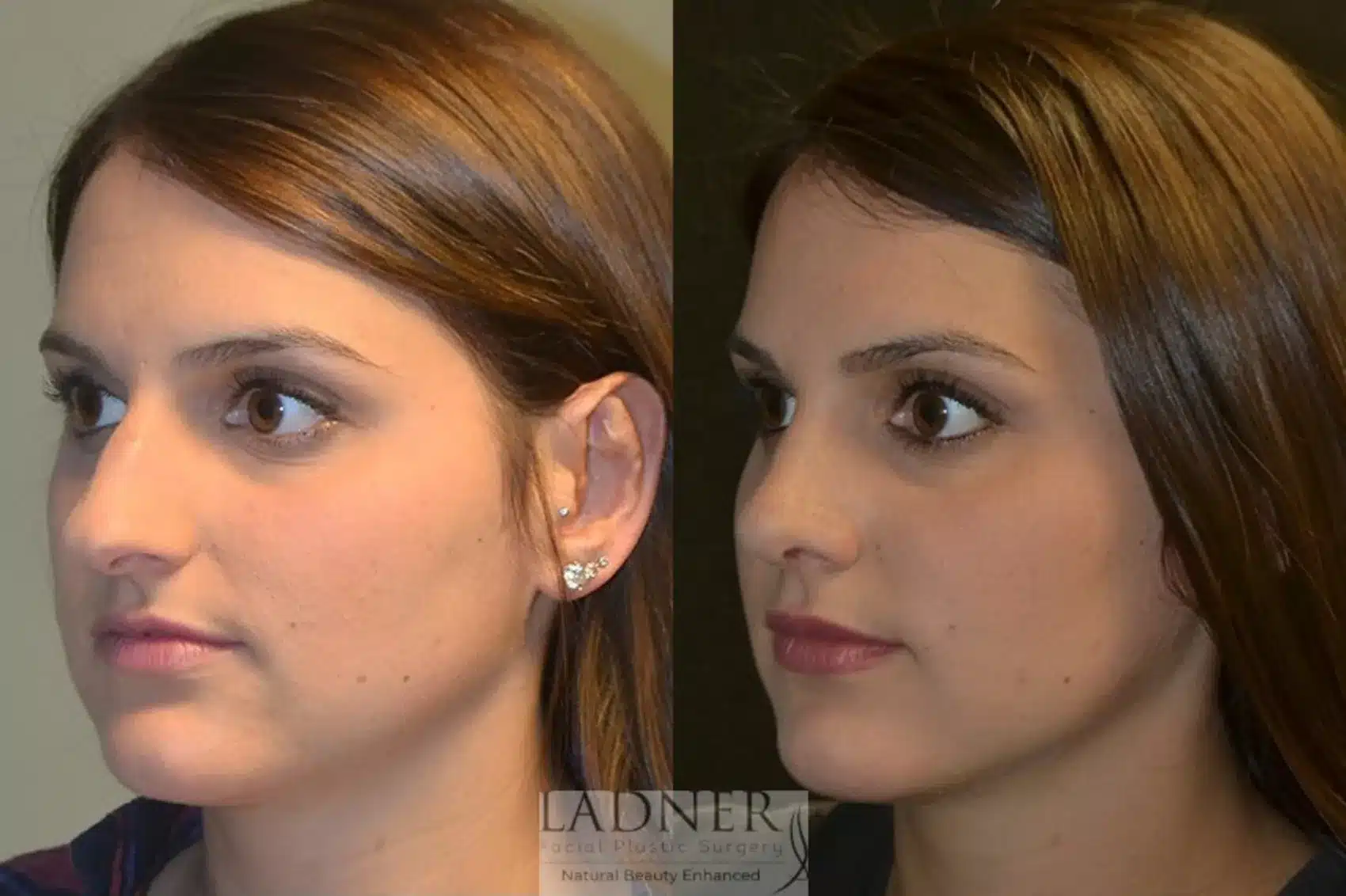 Before and After Image: Rhinoplasty - left-front-oblique