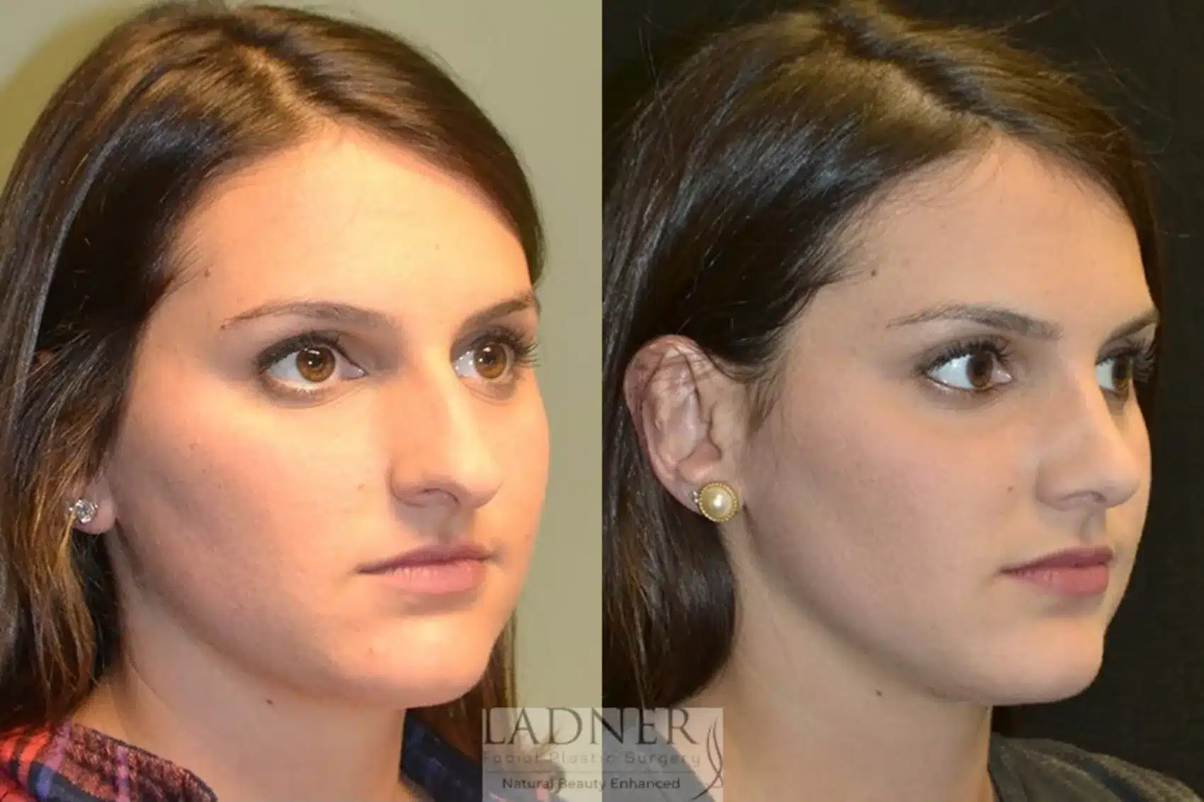 Before and After Image: Rhinoplasty - right-front-oblique