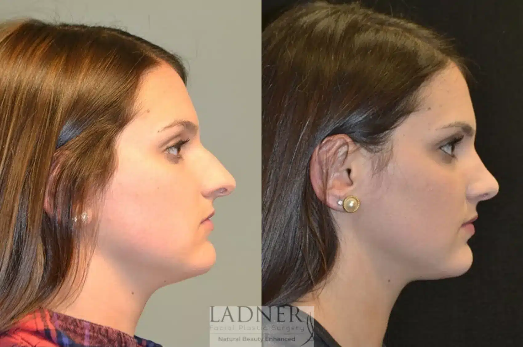 Before and After Image: Rhinoplasty - right-side
